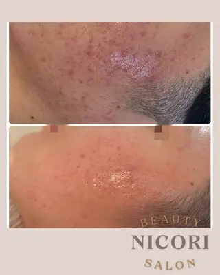 メンズ 小顔＆肌質改善 NICORIのエステ・リラクイメージ