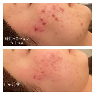 ミディアム カラー パーマ ヘアアレンジ メンズ キッズ ネイル マツエク・マツパ ニキビ跡専門サロン Ａｉｎａのエステ・リラクイメージ
