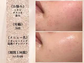 何をしても繰り返す ニキビ・ニキビ跡専門のエステ・リラクイメージ
