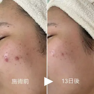 ニキビ・毛穴・ フェイシャル専門店のエステ・リラクイメージ