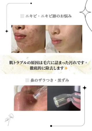 メンズ 肌質改善🫧 みゆのエステ・リラクイメージ