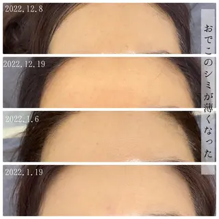 肌質改善美容鍼 ×ハーブピーリングのエステ・リラクイメージ