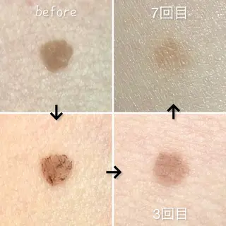 セミロング カラー メンズ キッズ セルフ脱毛 One Salonのエステ・リラクイメージ