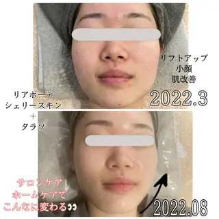 痩身ハイパーナイフ ララピールリアボーテのエステ・リラクイメージ
