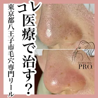 毛穴特化エステ -リールのエステ・リラクイメージ