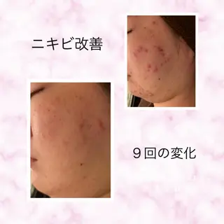 ミディアム カラー パーマ ヘアアレンジ メンズ キッズ ネイル マツエク・マツパ ニキビ跡専門サロン Ainaのエステ・リラクイメージ
