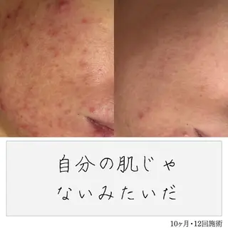 ニキビ経験者が施術 する専門サロン🌻のエステ・リラクイメージ