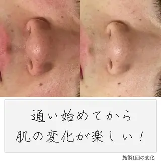 ニキビ経験者が施術 する専門サロン🌻のエステ・リラクイメージ