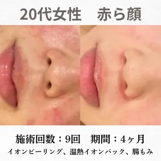 重度ニキビ専門🌼 ダウンタイムなしのエステ・リラクイメージ