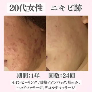 ニキビ・肌質改善専門 ♡人生が変わるサロンのエステ・リラクイメージ
