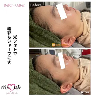 Meupニキビ専門店 背中/ハーブ/肌管理のその他イメージ