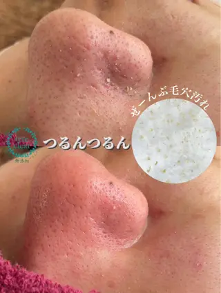 毛穴/シミ肝斑/脱毛 横山梨里のエステ・リラクイメージ