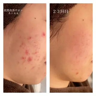 ミディアム カラー パーマ ヘアアレンジ メンズ ネイル マツエク・マツパ ニキビ跡専門サロン Ainaのエステ・リラクイメージ