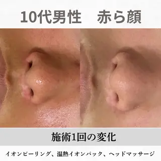 重度ニキビ専門🌼 ダウンタイムなしのエステ・リラクイメージ