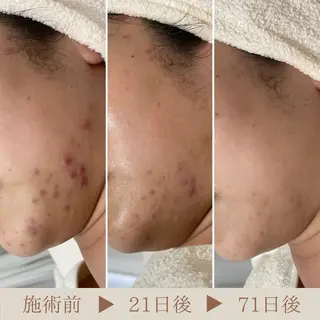 ニキビ・毛穴・ フェイシャル専門店のエステ・リラクイメージ