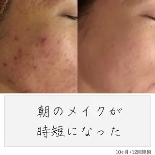 ニキビ経験者が施術 する専門サロン🌻のエステ・リラクイメージ