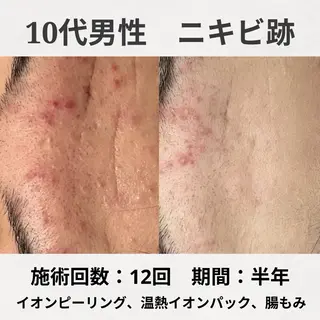 ニキビ跡改善専門🔥 医療にはできない改善のエステ・リラクイメージ