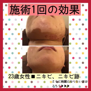 ミディアム パーマ ヘアアレンジ メンズ キッズ ネイル マツエク・マツパ ニキビ・肌質改善専門 ♡人生が変わるサロンのエステ・リラクイメージ