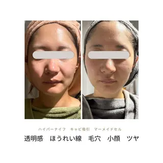 痩身ハイパーナイフ ララピールリアボーテのエステ・リラクイメージ