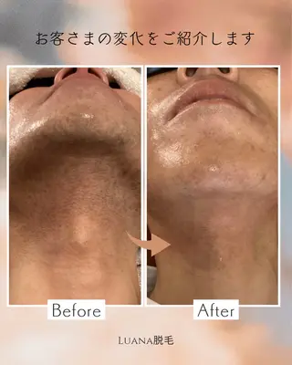 脱毛サロンLuana 山本沙由理のエステ・リラクイメージ