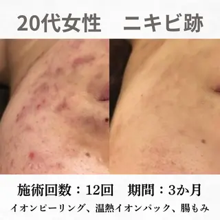 重度ニキビ専門🌼 ダウンタイムなしのエステ・リラクイメージ