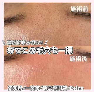 毛穴/シミ肝斑/脱毛 横山梨里のエステ・リラクイメージ
