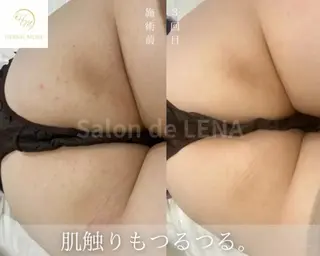 毛穴ニキビ肌改善専門 ハーブピーリング専門のエステ・リラクイメージ