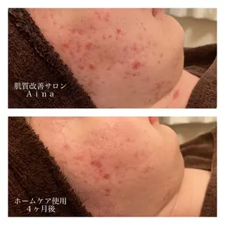 ショート カラー パーマ ヘアアレンジ メンズ キッズ ネイル マツエク・マツパ ニキビ跡専門サロン Ainaのエステ・リラクイメージ