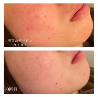 ショート カラー パーマ ヘアアレンジ メンズ キッズ ネイル マツエク・マツパ ニキビ跡専門サロン Ainaのエステ・リラクイメージ