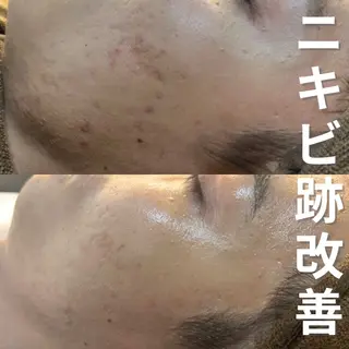 ニキビ・ニキビ跡改善 leoloのエステ・リラクイメージ