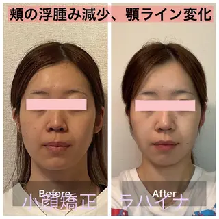 小顔矯正 ラハイナのエステ・リラクイメージ