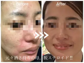 毛穴開き黒ずみ ニキビ特化💆♀️のエステ・リラクイメージ