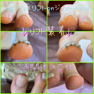 ネイル ♢ME2ROOM♢ #巻き爪#リラクのネイルデザイン