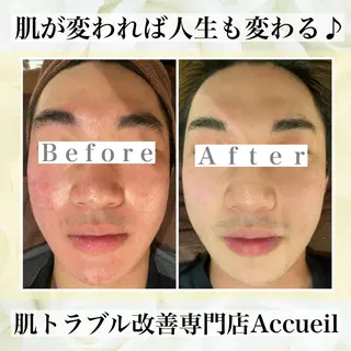 ミディアム カラー パーマ ヘアアレンジ メンズ キッズ ネイル マツエク・マツパ ニキビ・肌質改善専門 ♡人生が変わるサロンのエステ・リラクイメージ