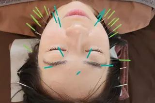 即効⚡小顔美容鍼🪡 むくみたるみケア鍼!のエステ・リラクイメージ