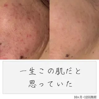 ニキビ経験者が施術 する専門サロン🌻のエステ・リラクイメージ