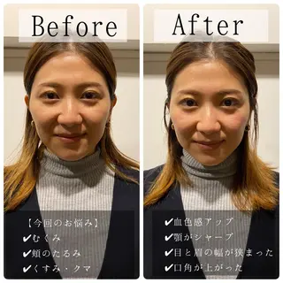 肌質改善美容鍼 ×ハーブピーリングのエステ・リラクイメージ