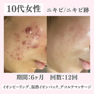 ニキビ・肌質改善専門 ♡人生が変わるサロンのエステ・リラクイメージ
