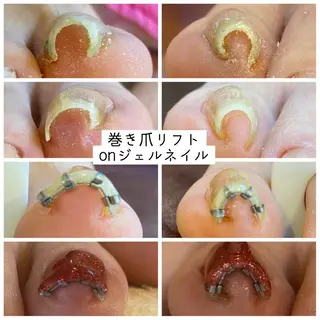 ネイル ♢ME2ROOM♢ #巻き爪#リラクのネイルデザイン