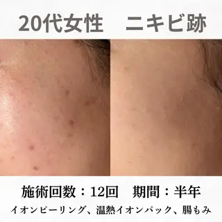 重度ニキビ専門🌼 ダウンタイムなしのエステ・リラクイメージ