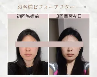 リフトアップ小顔矯正 いまいあやののその他イメージ