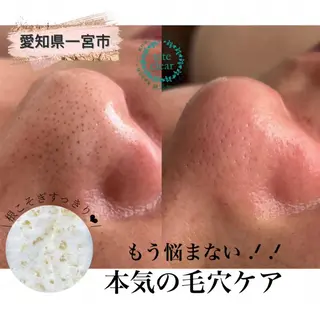 毛穴/シミ肝斑/脱毛 横山梨里のエステ・リラクイメージ