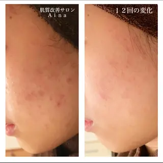 ミディアム カラー パーマ ヘアアレンジ メンズ キッズ ネイル マツエク・マツパ ニキビ跡専門サロン Ａｉｎａのエステ・リラクイメージ