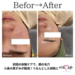 Meupニキビ専門店 背中/ハーブ/肌管理のその他イメージ