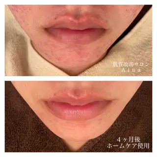 ミディアム カラー パーマ ヘアアレンジ メンズ キッズ ネイル マツエク・マツパ ニキビ跡専門サロン Ainaのエステ・リラクイメージ