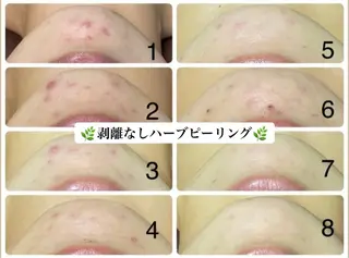 脱毛/肌質改善 《ulula~梟》のエステ・リラクイメージ