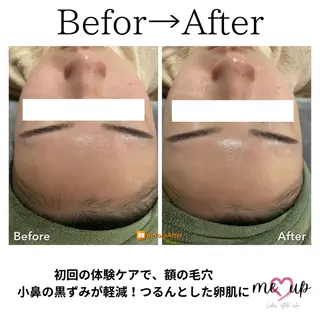 Meupニキビ専門店 背中/ハーブ/肌管理のその他イメージ