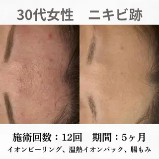 重度ニキビ専門🌷 ダウンタイムなしのエステ・リラクイメージ