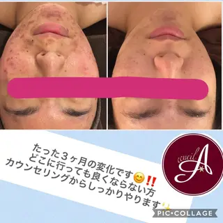 ミディアム カラー パーマ ヘアアレンジ メンズ キッズ ネイル マツエク・マツパ ニキビ・肌質改善専門 ♡人生が変わるサロンのエステ・リラクイメージ