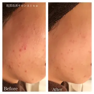 セミロング カラー パーマ ヘアアレンジ キッズ ネイル マツエク・マツパ ニキビ跡専門サロン Ainaのエステ・リラクイメージ